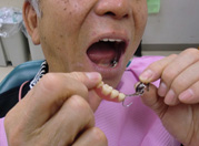 エプロン型義歯
