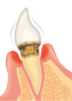 歯周病の進行具合と治療方法